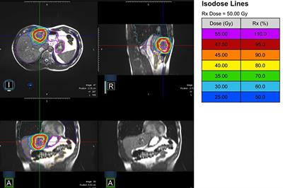 Magnetic Resonance-Guided Stereotactic Body Radiotherapy of Liver Tumors: Initial Clinical Experience and Patient-Reported Outcomes